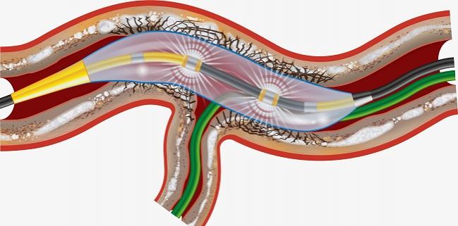 FDA Approves Shockwave Intravascular Lithotripsy for Calcified Coronaries